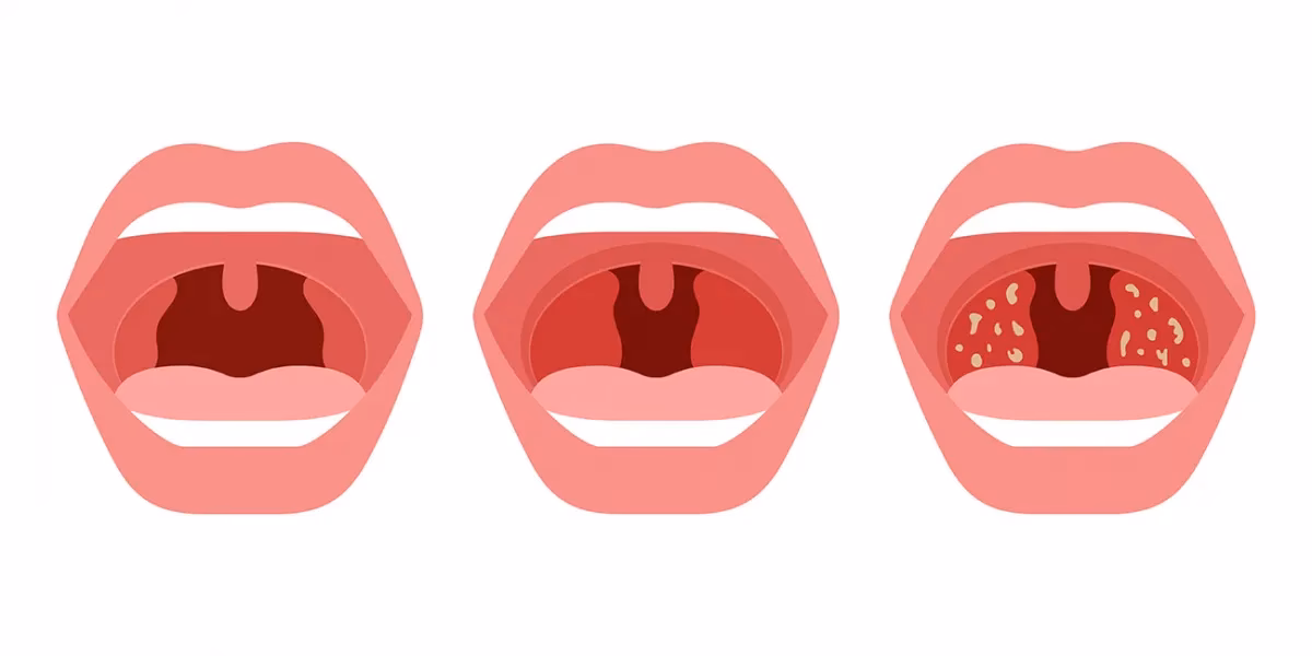 ¿Cuántos días de reposo por amigdalitis?