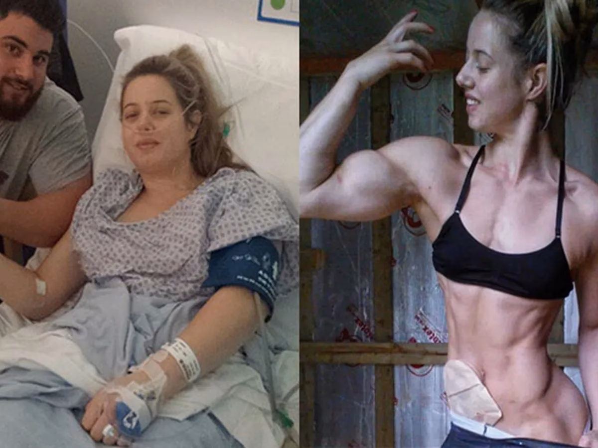 ¿Qué pasa si hago ejercicio y tengo colitis?