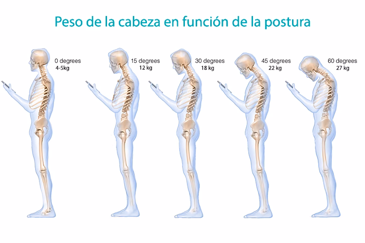 ¿Cómo saber si mi dolor de cuello es muscular?