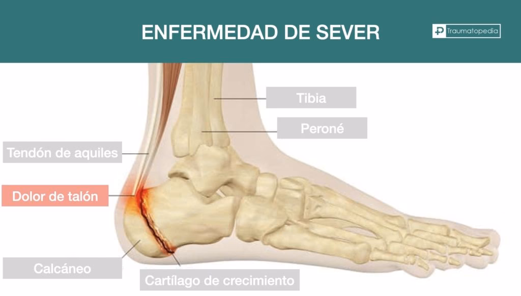¿Cómo calmar el dolor de talón en niños?