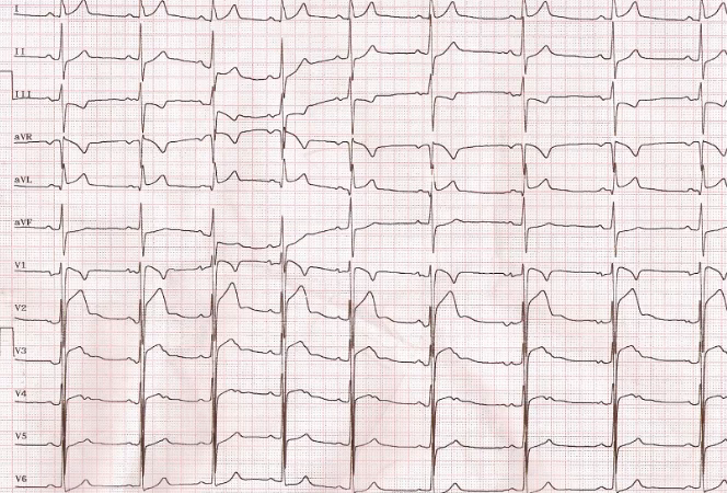 ¿Qué son los hallazgos electrocardiográficos?