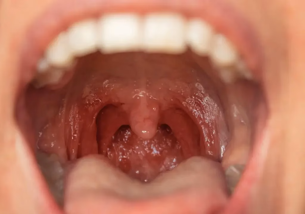 ¿Qué debo evitar si tengo faringitis?