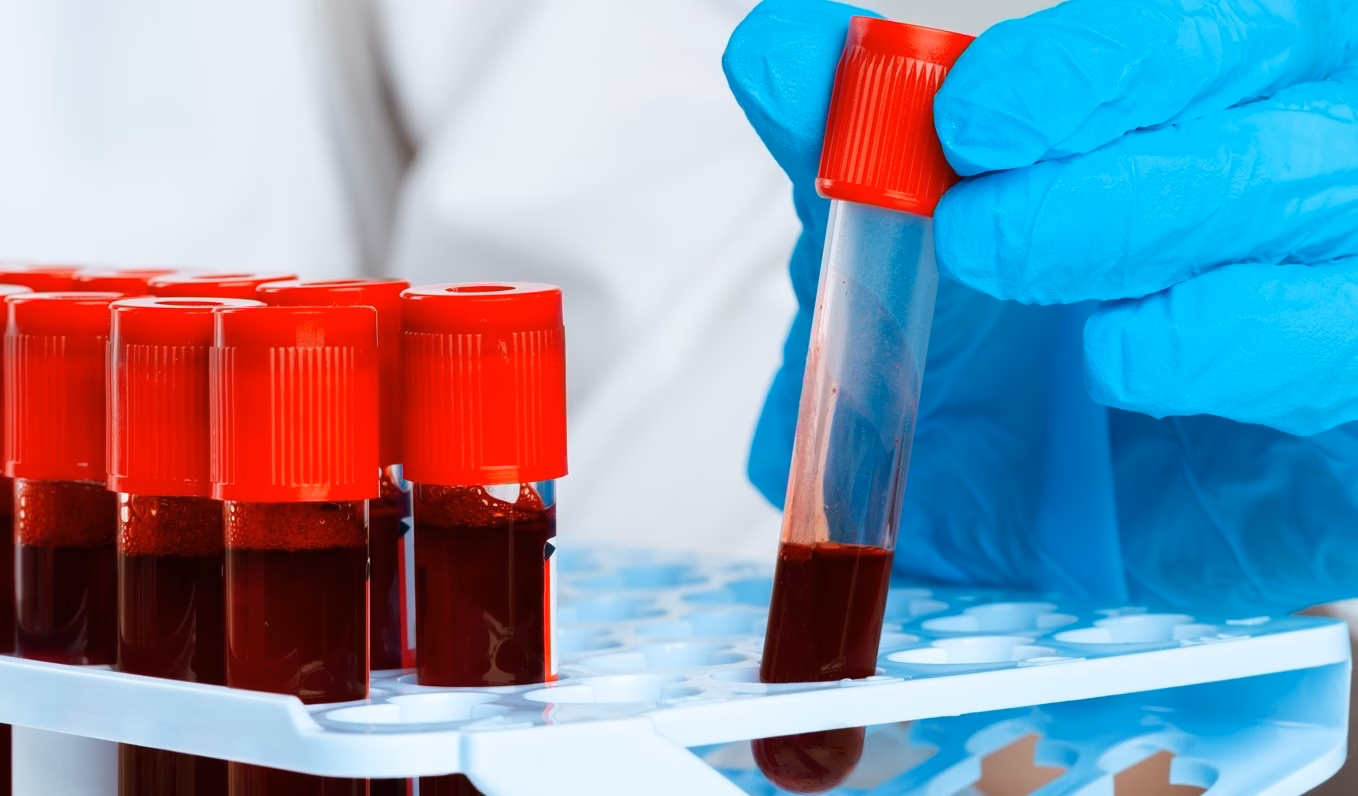 ¿Qué puede provocar el hematocrito alto?