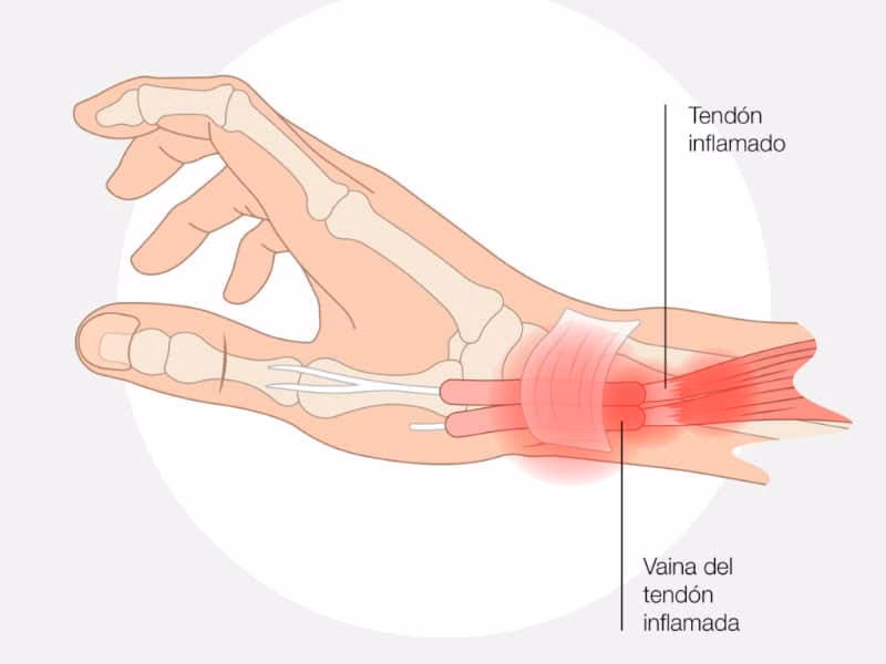 ¿Cómo saber si te has lesionado la muñeca?