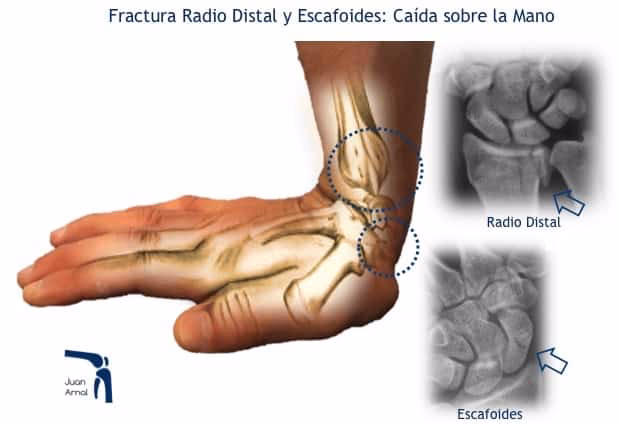 ¿Cuáles son las lesiones de muñeca más comunes?