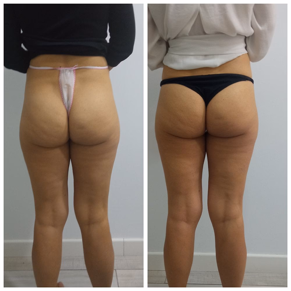 ¿Es bueno hacer ejercicio después de la presoterapia?