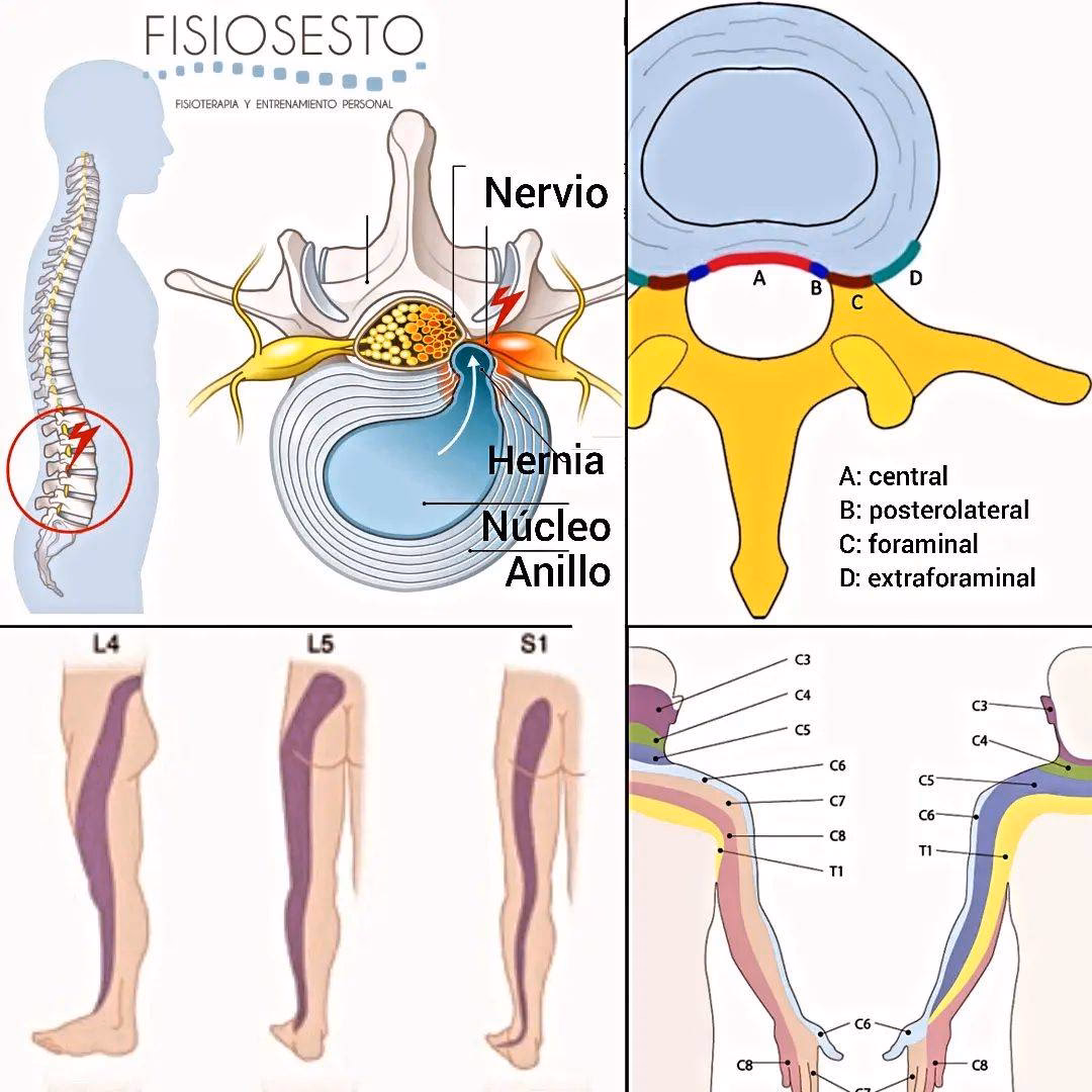 ¿Cuánto tarda en curarse una protusión?